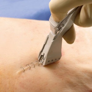 Sutures – agrafeuses et ôte-agrafes